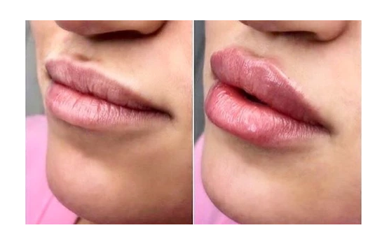 Hyaluronic Lip Injection (NeedleLESS) Training [Class in Atlanta